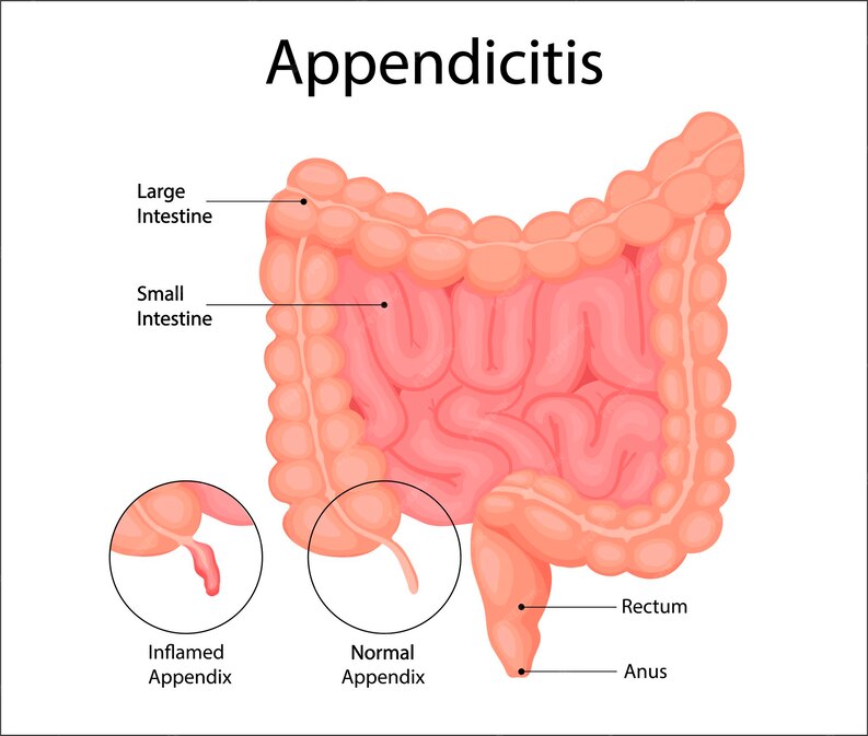 Appendicitis Causes, Symptoms, and Treatment Explained