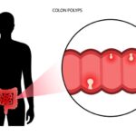 Colon Polyps