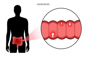 Colon Polyps