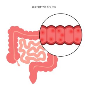 Ulcerative Colitis Causes, Symptoms, and Key Factors.