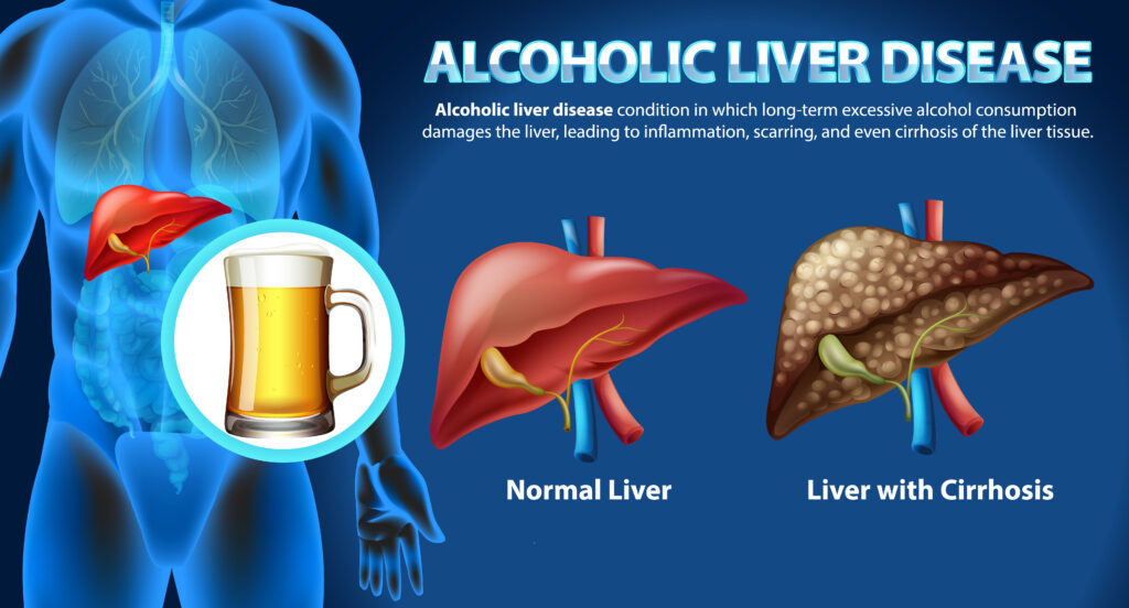 Alcohol Related Liver Disorder