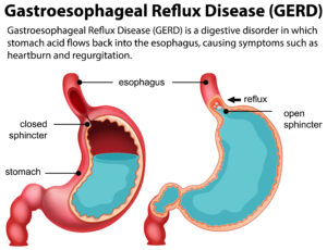 Gastroesophageal Reflux Disease (GERD) Diagram illustration