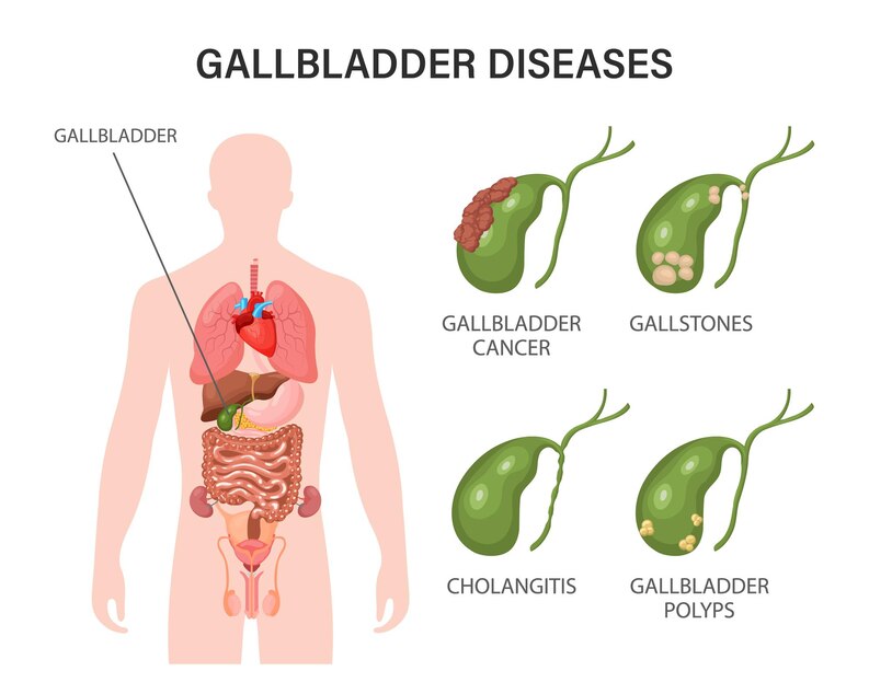 Gallstones Causes, Risk Factors, and Diagnostic Approaches