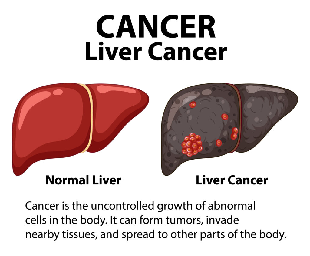 Liver Cancer