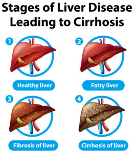 Liver Cirrhosis