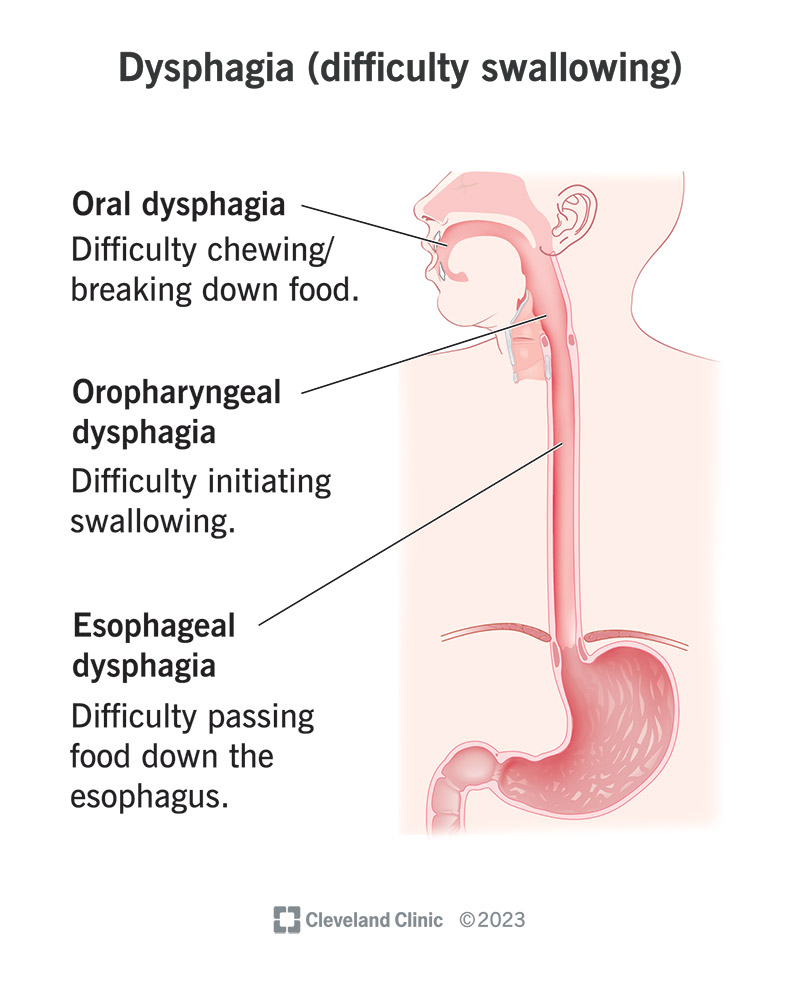 Swallowing Disorders