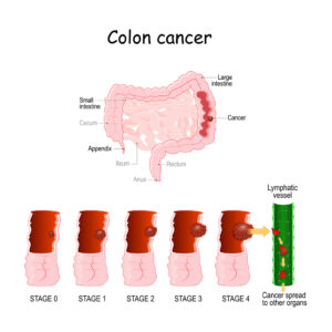 colon cancer