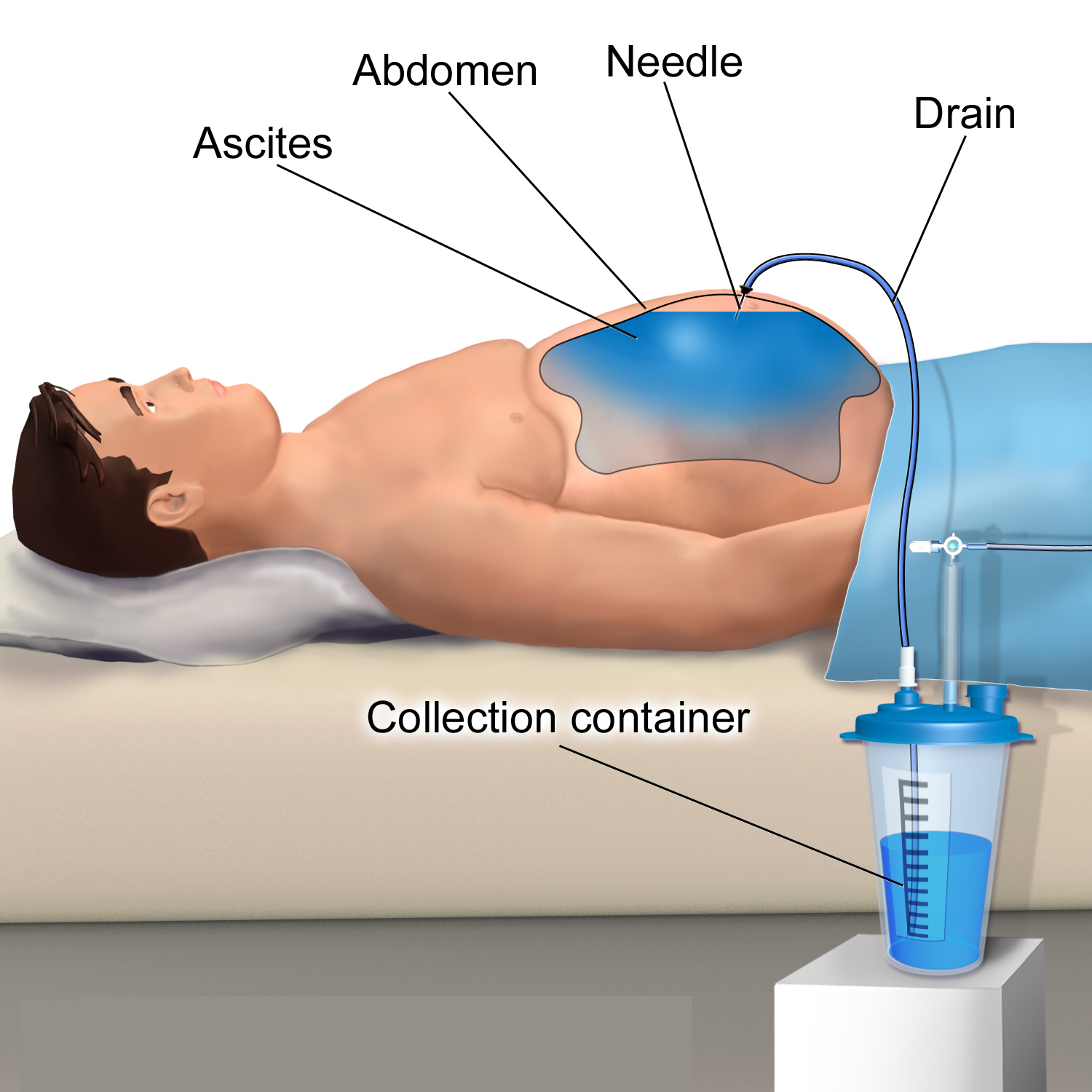 Ascitic Fluid Tapping