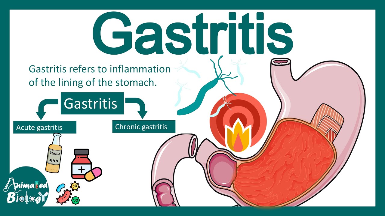 Gastritis