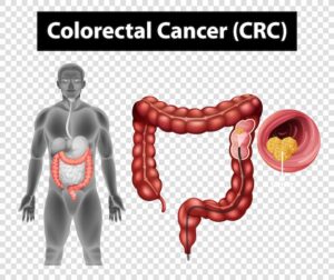 Colorectal Cancer Prevention