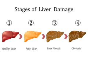 Fatty Liver Disease