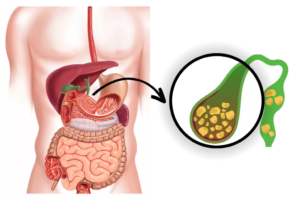 Gallbladder Stone