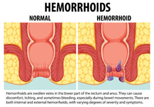 Hemorrhoids