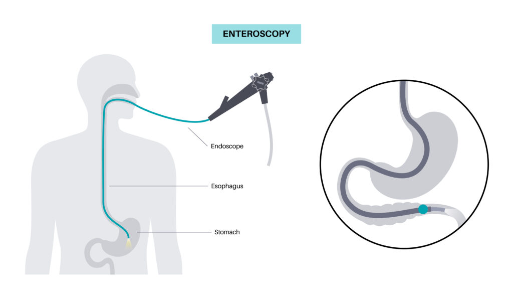 Endoscopy