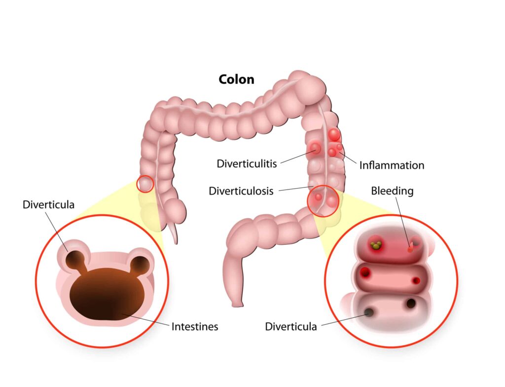 colon pain