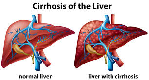 Liver Cirrhosis