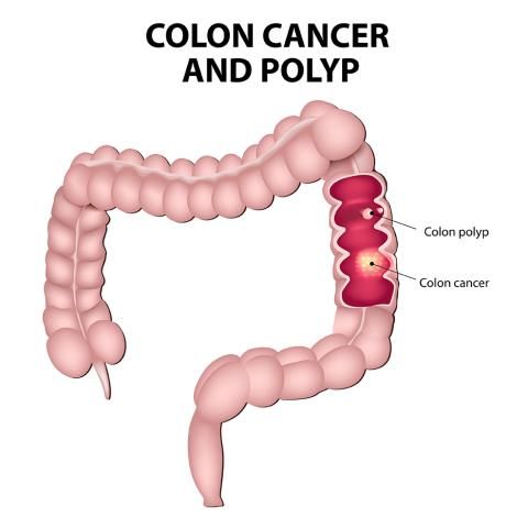 Colon Cancer Prevention Tips