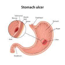 Understanding Stomach Ulcers