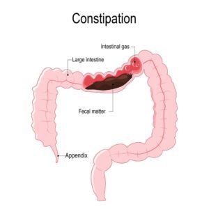 Chronic Constipation