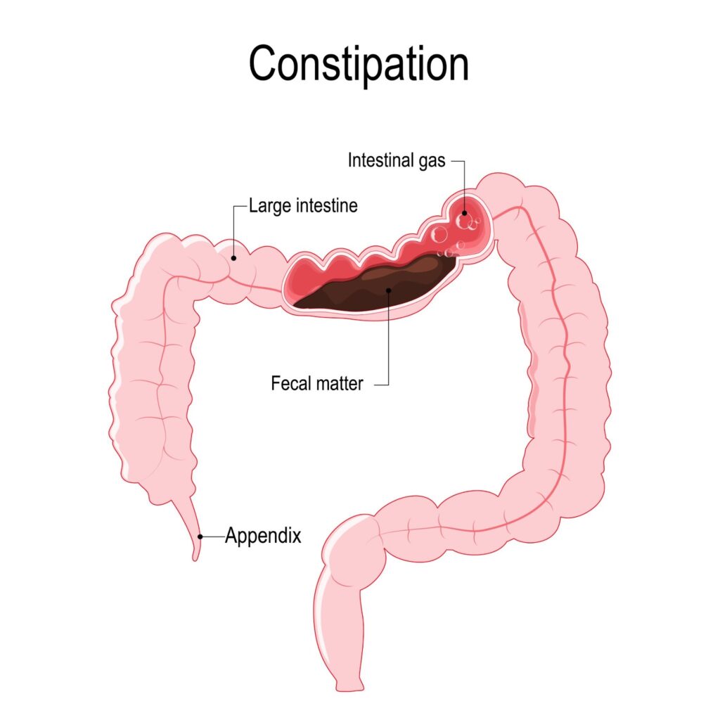 Chronic Constipation