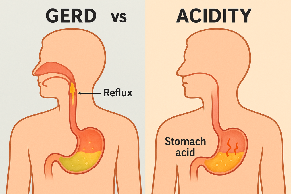 GERD vs. Acidity