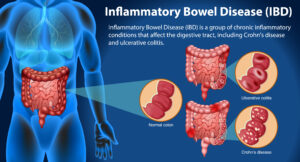 IBS Irritable Bowel Syndrome