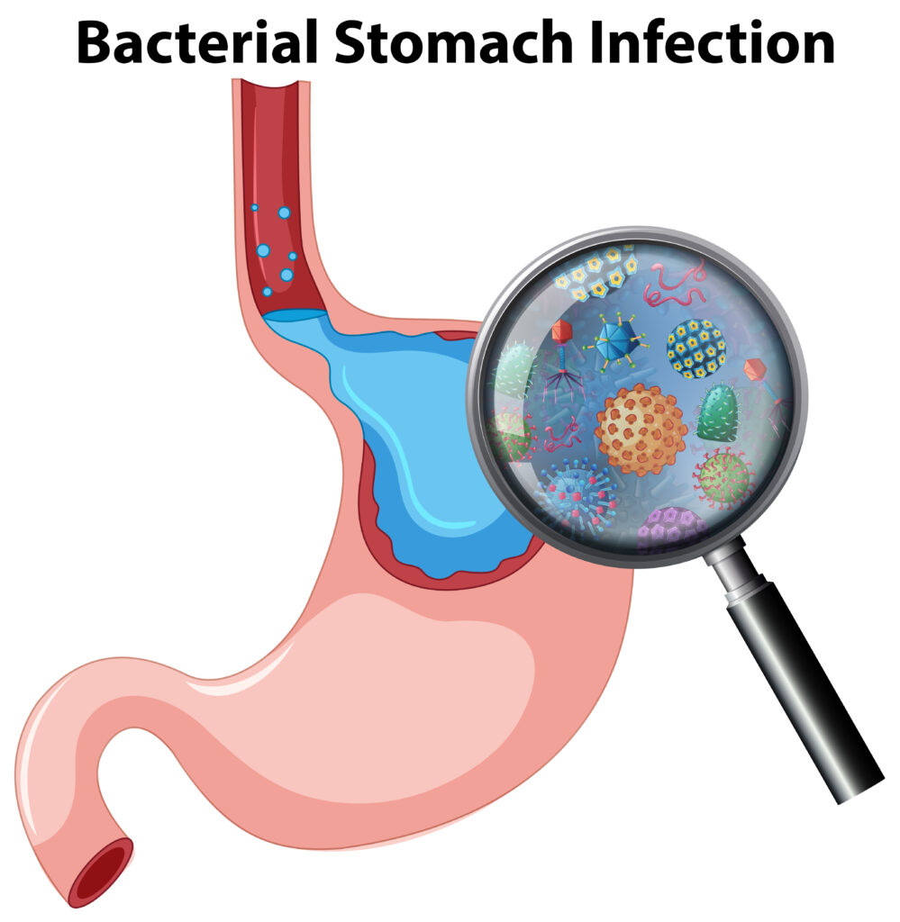 Stomach Infection