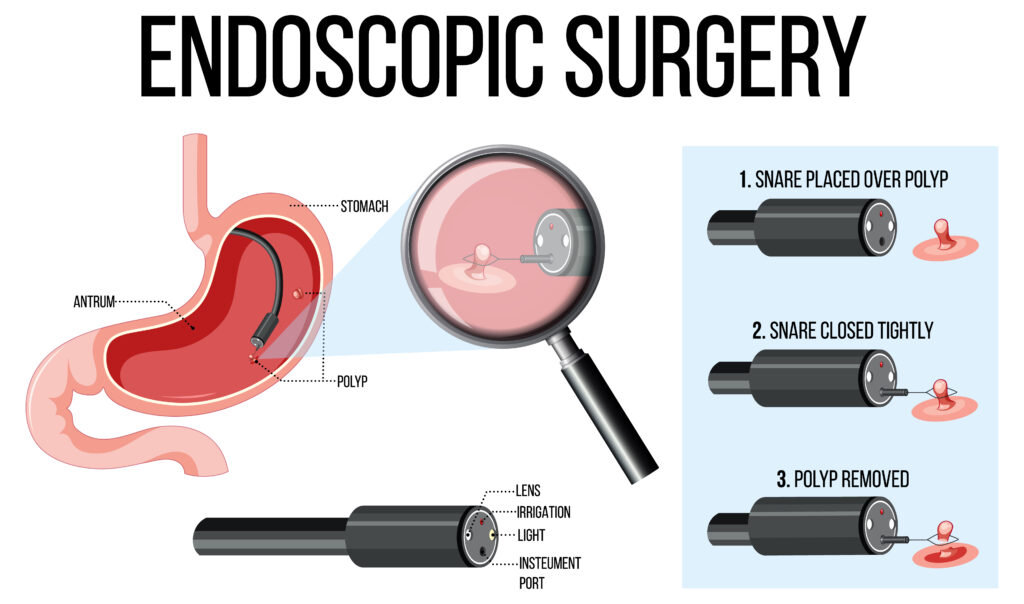 Endoscopy